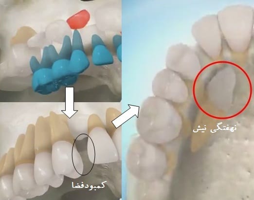 علت نهفته شدن دندان نیش 