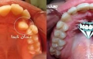 دندان نهفته چرا ایجاد می شود و چگونه می توان آن را پیشگیری/درمان کرد؟