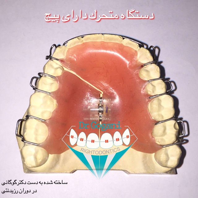 دستگاه ارتودنسی متحرک دارای پیچ active removable