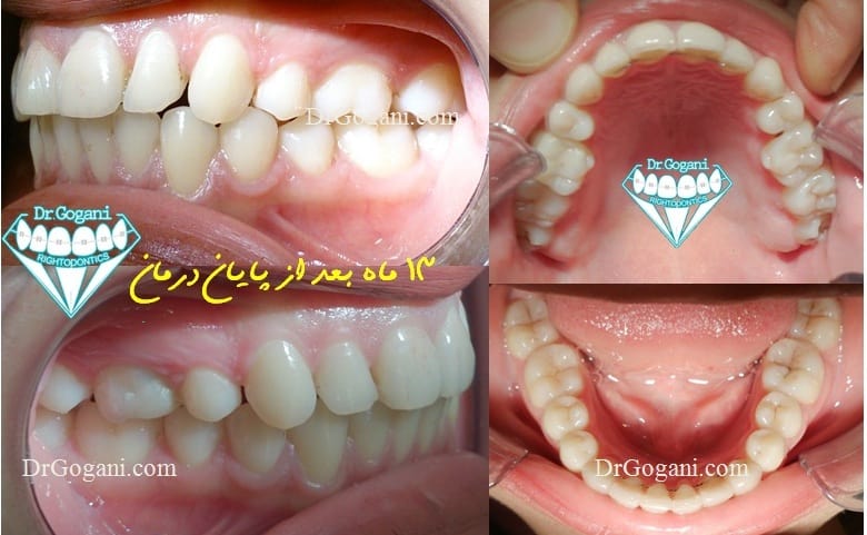 13 month post retention