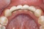 ارتودنسی بدون کشیدن دندان