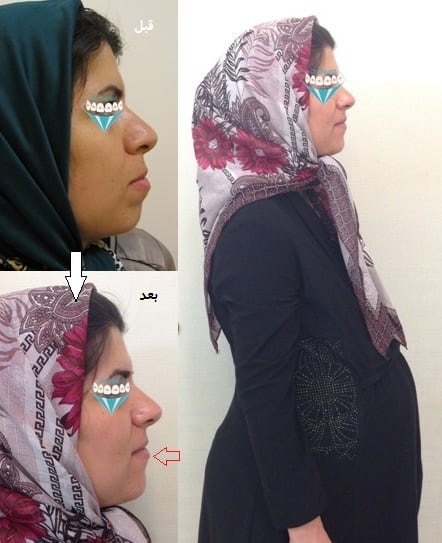 خانم باردار ( حامله ) در حال اتمام ارتودنسی