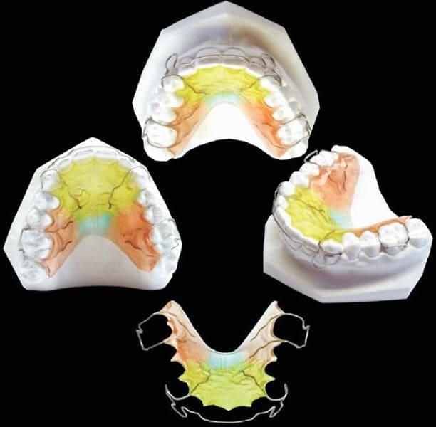 Acrylic retainer