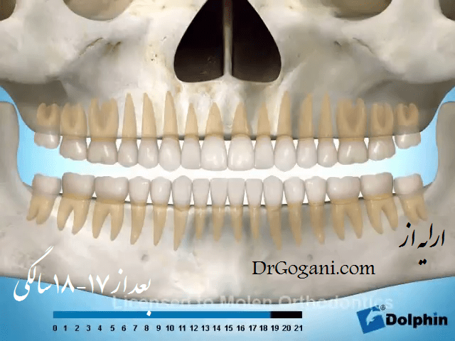 ارتودنسی بعد از بلوغ جراحی