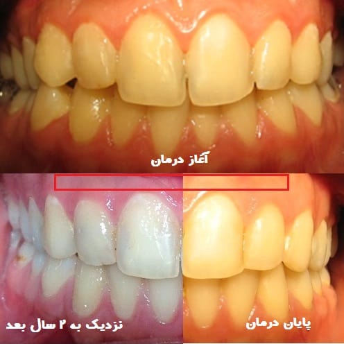 تغییر رنگ در ارتودنسی ؟