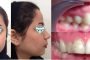 درمان بی نظمی و برجستگی دندان ها