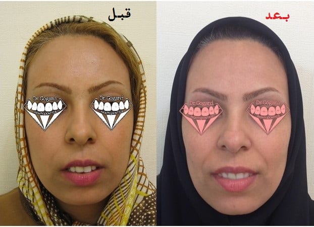 درمان ارتودنسی بزرگس بدون کشیدن و جراحی