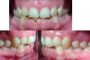 درمان نامرتبی دندان ها و تمایل ClII