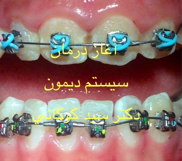 اورینگ رنگی در ارتودنسی سیستم دیمون توسط دکترگوگانی