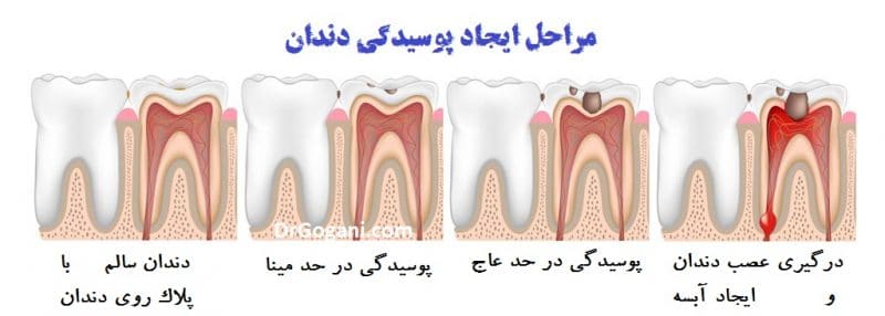 مراحل پوسیدگی دندان