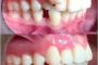 درمان برجستگی دندان ها و لب ها و بستن فضا