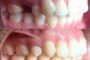 درمان دندان های نامرتب: ارتودنسی یا لمینیت؟ مساله این است!