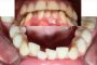 نجات لیلا ن. از جراحی فک: درمان  برجستگی دندانی و لب پایین - کراس بایت - کلاس III
