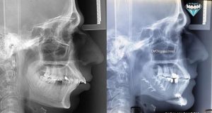 رادیوگرافی سفالومتری قبل و بعد از ارتودنسی به همراه جراحی فک و صورت