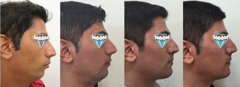 فرم صورت قبل و بعد از ارتودنسی + جراحی فک