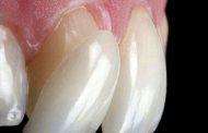 آیا کسی که لمینیت دندان دارد می تواند ارتودنسی کند؟