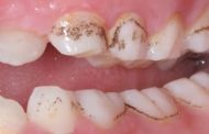 قطره آهن چطور باعث تغییر رنگ دندان می شود و راه پیشگیری چیست؟