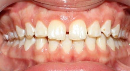 فاصله بین دندان‌ها