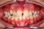دندان خراب قبل از ارتودنسی باید ترمیم شود؟