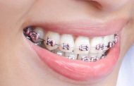 مرتب کردن دندان با ارتودنسی یا لیزر