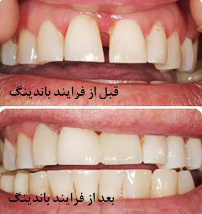 باندینگ دندان
