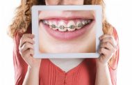 ارتودنسی و کشیدن دندان