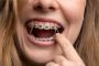 مزایا و معایب ارتودنسی از پشت دندان