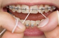 نخ دندان در ارتودنسی