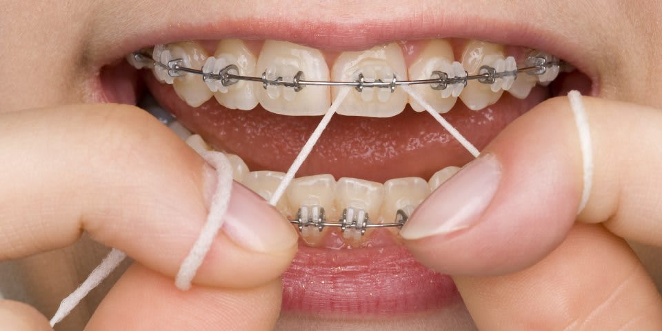 نخ دندان در حین ارتودنسی