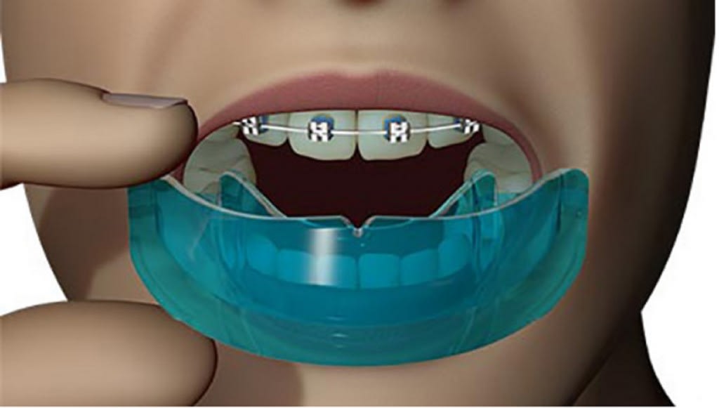 محافظت کننده های ارتودنسی و دندان