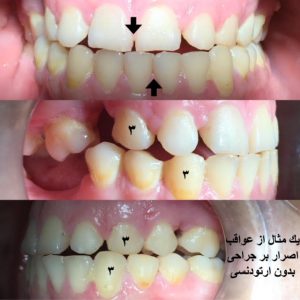 عوارض جراحی فک بدون ارتودنسی