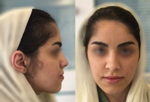 ارتودنسی فوق تخصصی - صورت در زمان شروع