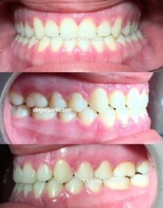 ارتودنسی فوق تخصصی - دندان ها در پایان