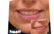کراس بایت تک دندان قدامی - عکس قبل و بعد از ارتودنسی