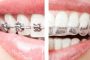کراس بایت تک دندان قدامی - عکس قبل و بعد از ارتودنسی