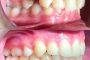 کامپوزیت دندان نامناسب - پشیمانی و اقدام به ارتودنسی