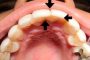 کامپوزیت دندان نامناسب - پشیمانی و اقدام به ارتودنسی